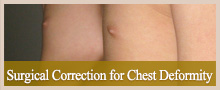 Surgical Correction for Chest Deformity